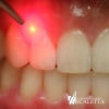 Parodontite  e  piorrea alveolare utilizzo del laser come parte integrante della moderna medicina